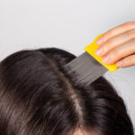 Itchy Scalp Treatments