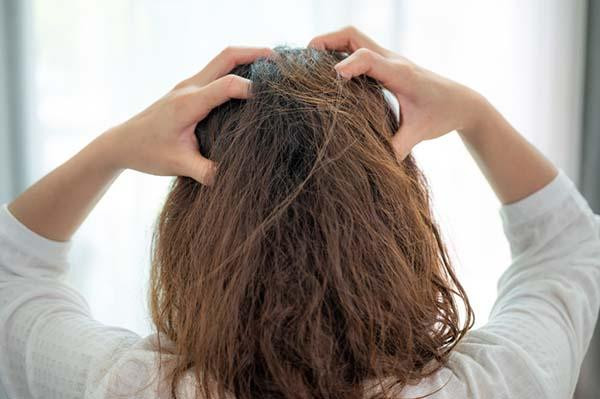 Itchy Scalp Treatments
