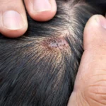 What Make Itchy Scalp Treatments Truly Effective