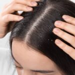 What Itchy Scalp Treatments Do During Winter Months