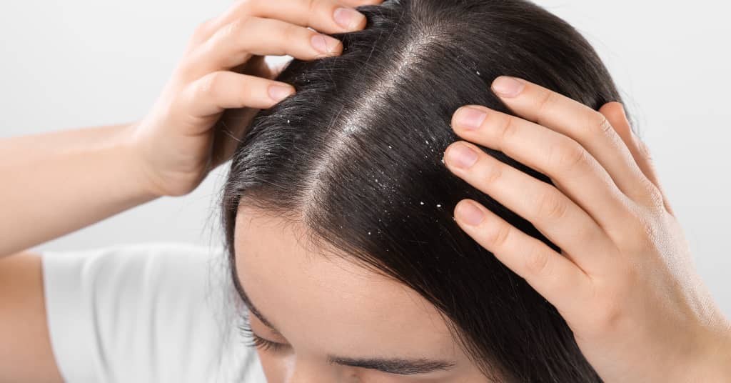 What Itchy Scalp Treatments Do During Winter Months