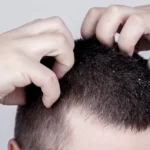 When Itchy Scalp Treatments Should Be Applied