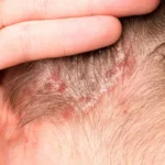 Can Itchy Scalp Treatments Stop Overnight Itching