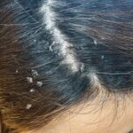 Where Itchy Scalp Treatments Help The Most