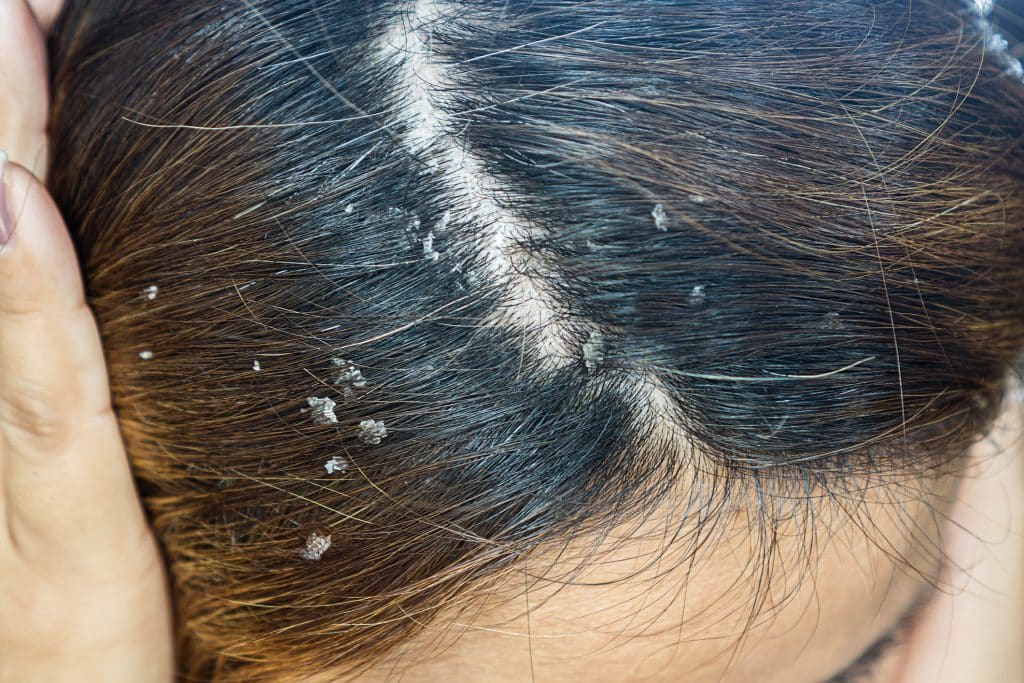Where Itchy Scalp Treatments Help The Most