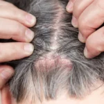 Why Itchy Scalp Treatments Benefit Sensitive Skin