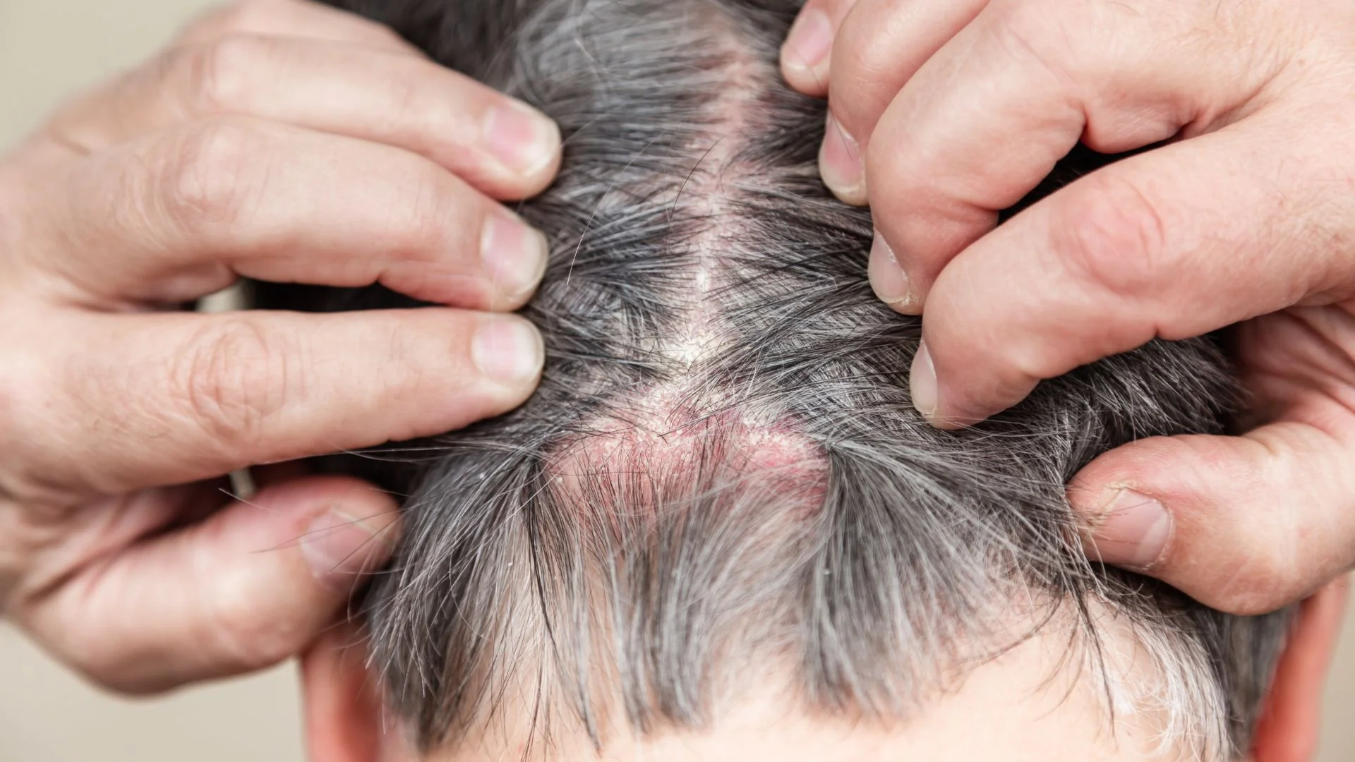 Why Itchy Scalp Treatments Benefit Sensitive Skin