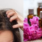 Should Itchy Scalp Treatments Include Natural Oils